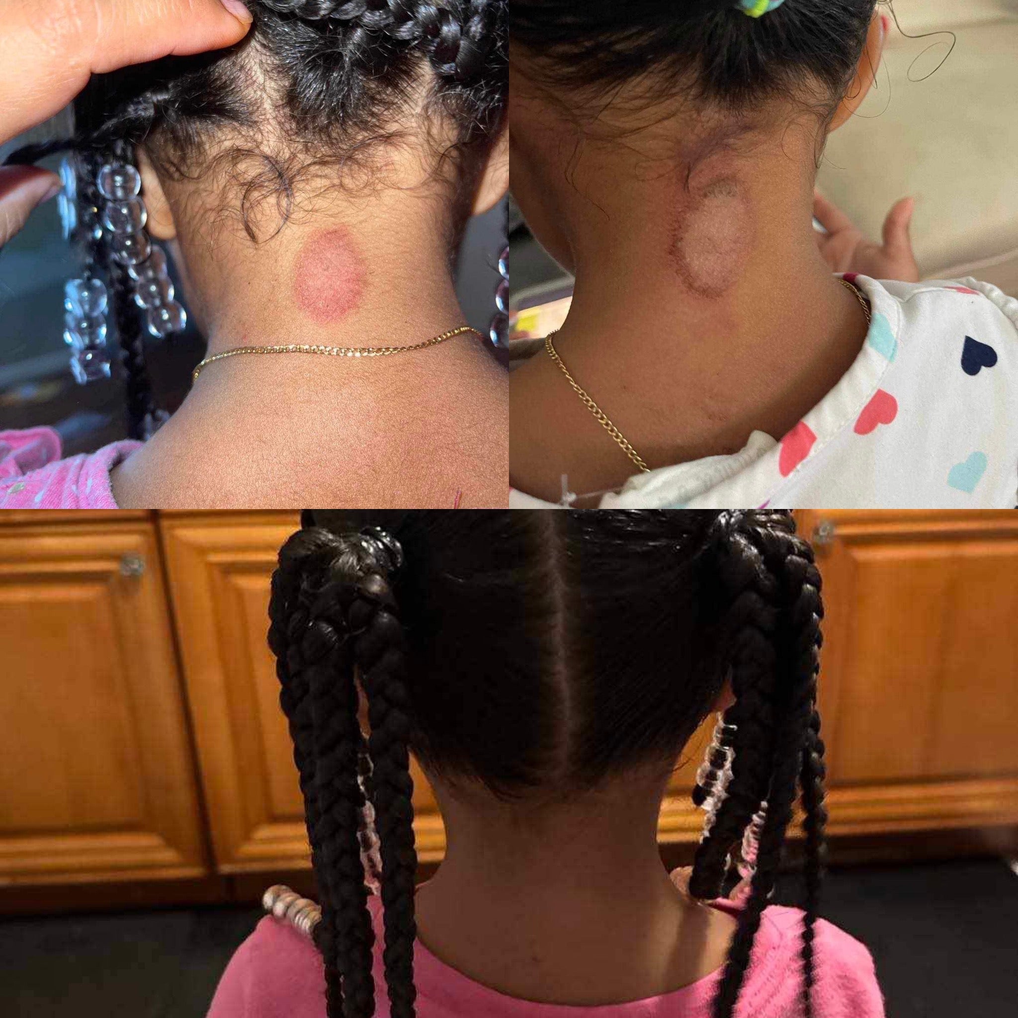 1oz Eczema Oil Bundle