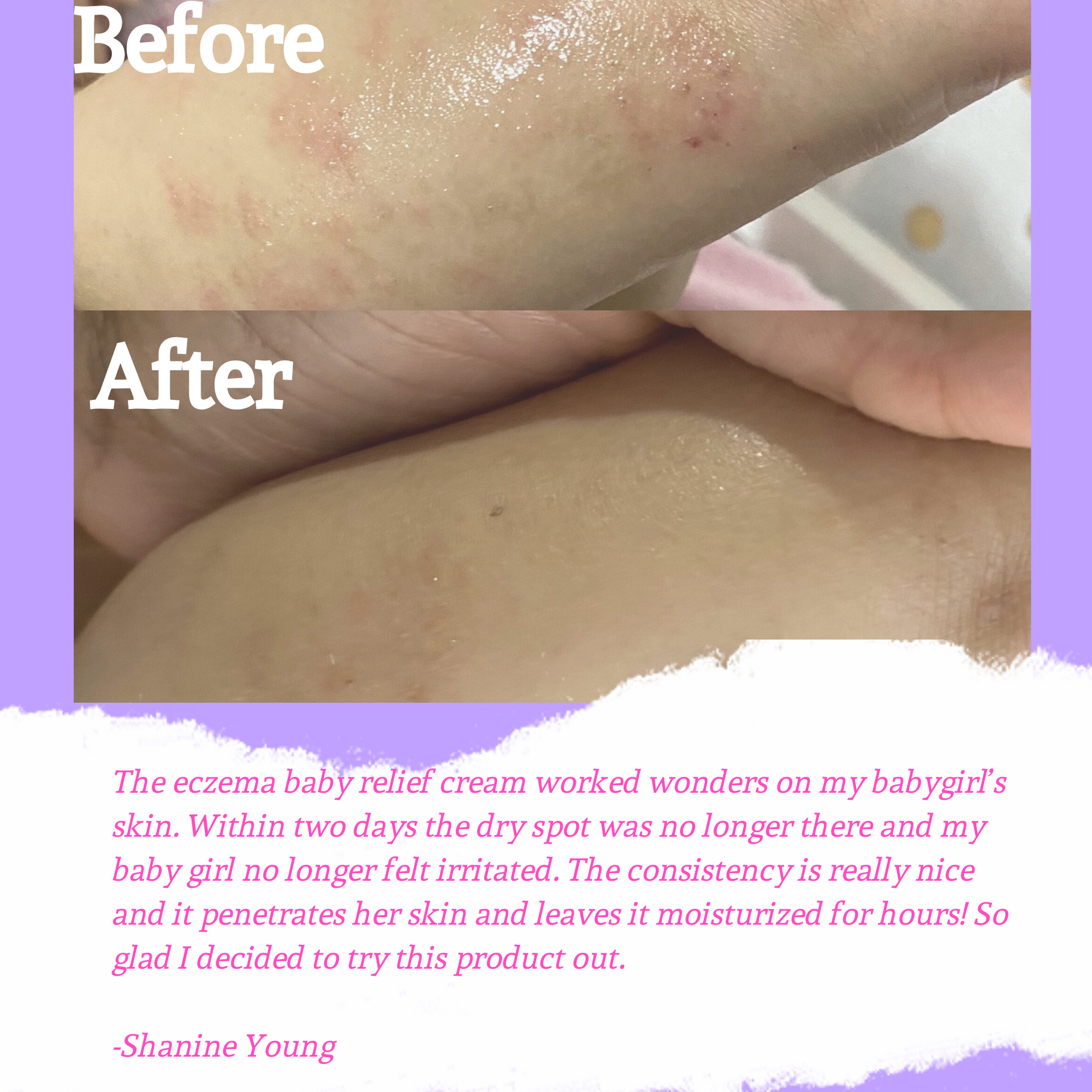 Soothing Eczema Anti Itch Relief Butter
