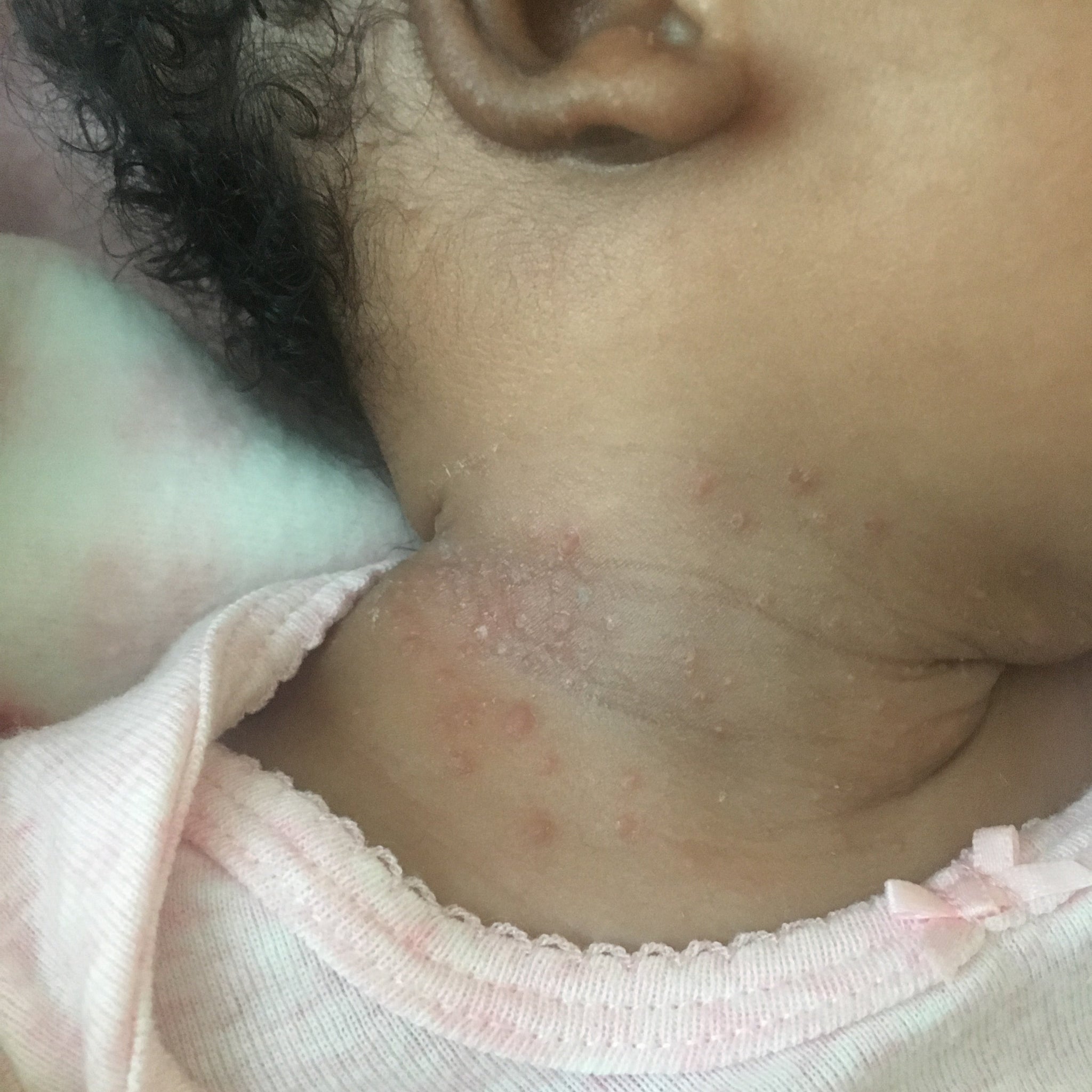 1oz Eczema Oil Bundle