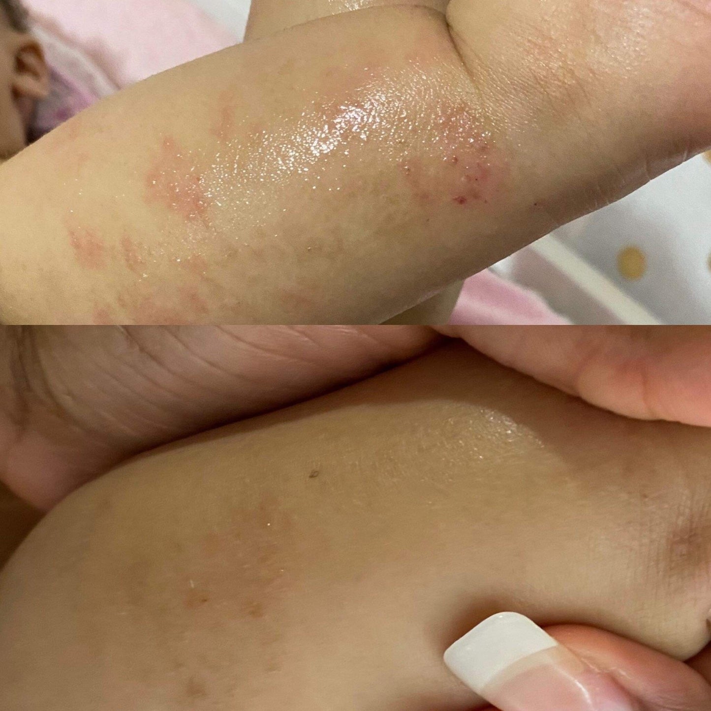 Eczema Skin Oil Treatment - Aubrey's Baby Goodies