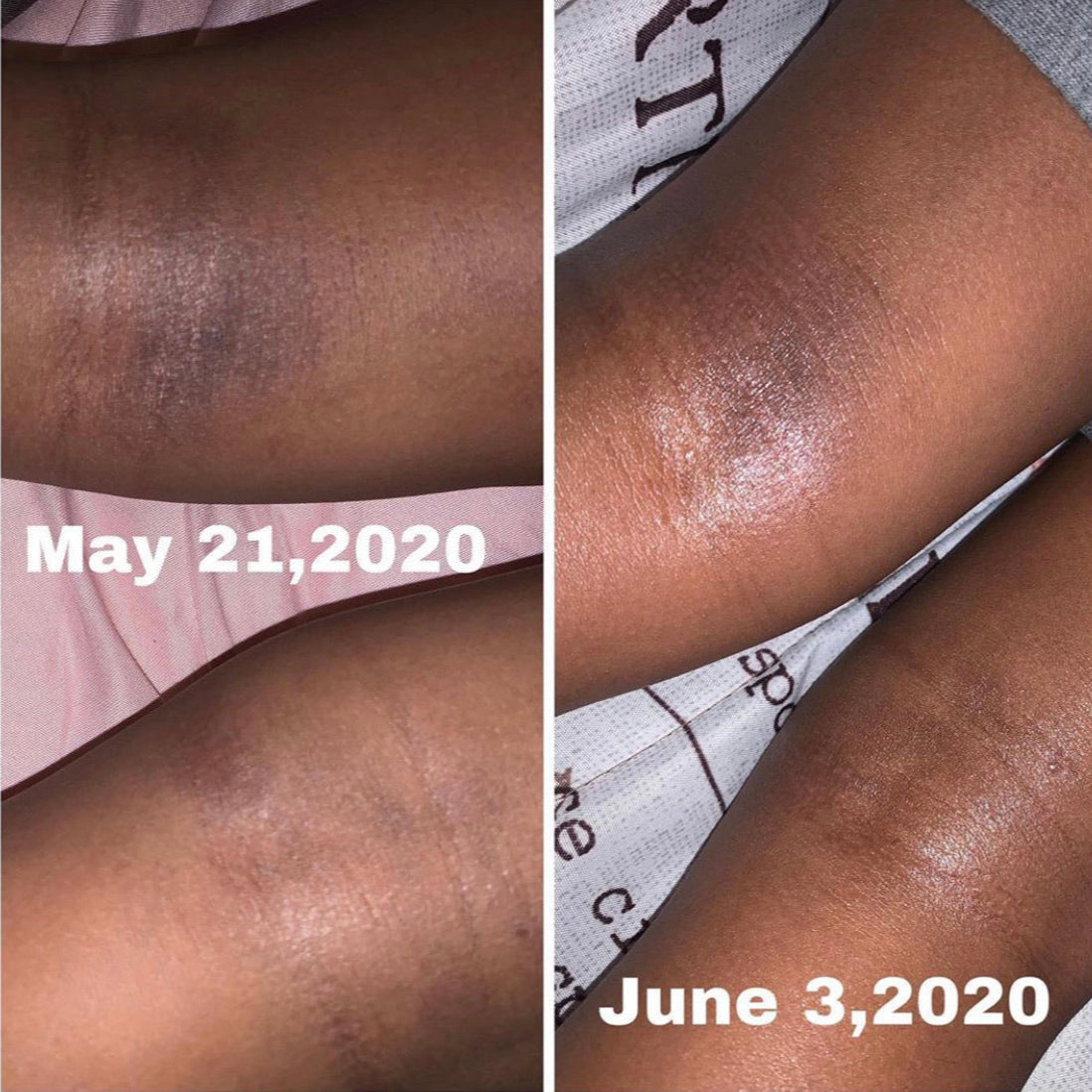 Eczema Skin Oil Treatment - Aubrey's Baby Goodies